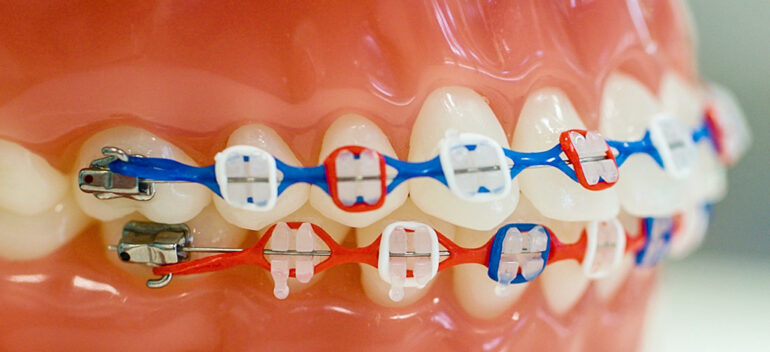 St. Johns FL Metal Braces Orthodontist