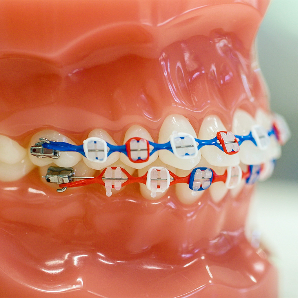 St. Johns FL Metal Braces Orthodontist
